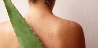 Aloe Vera pentru acnee: Un ghid de utilizare pentru cosuri